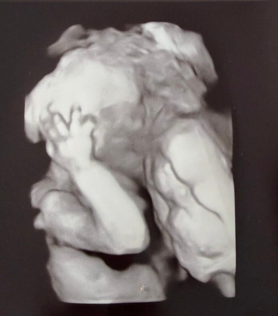 Ecografía 3D de un bebé con la mano junto a la cara durante un embarazo arcoíris